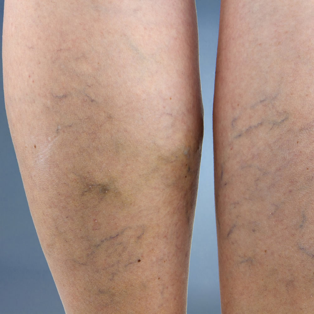 Varicose Veins Treatment in El Paso & Las Cruces