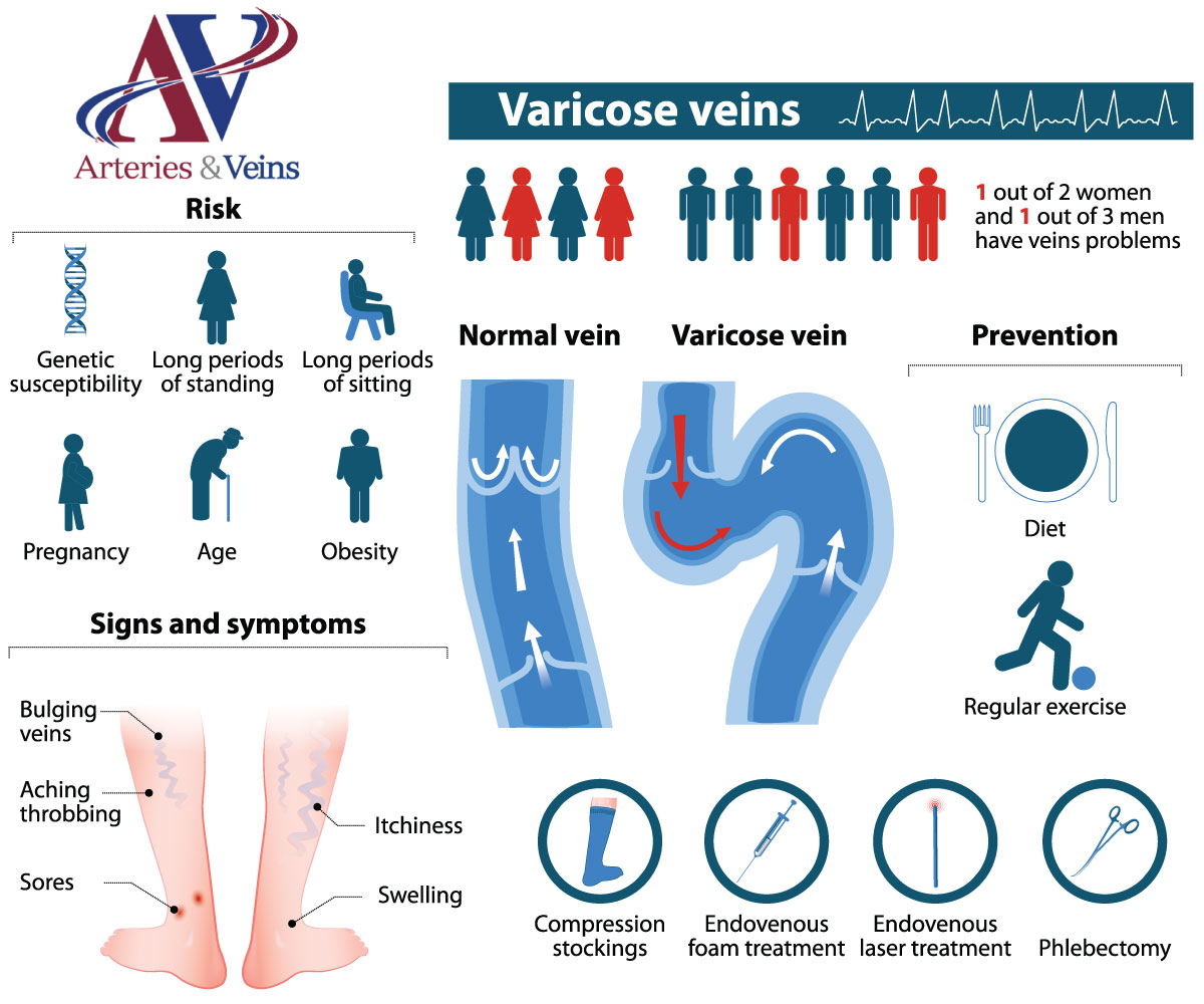 Treatment for Spider Veins & Varicose Veins - Holy Cross Medical