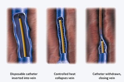 VNUS Closure - Varicose Veins Treatment in El Paso, TX